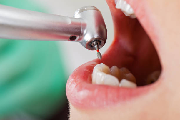 Best Broken or Cracked Tooth Emergency Dentist in Azalea Park, FL